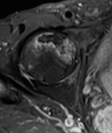 Hip AVN MRI Anterior head